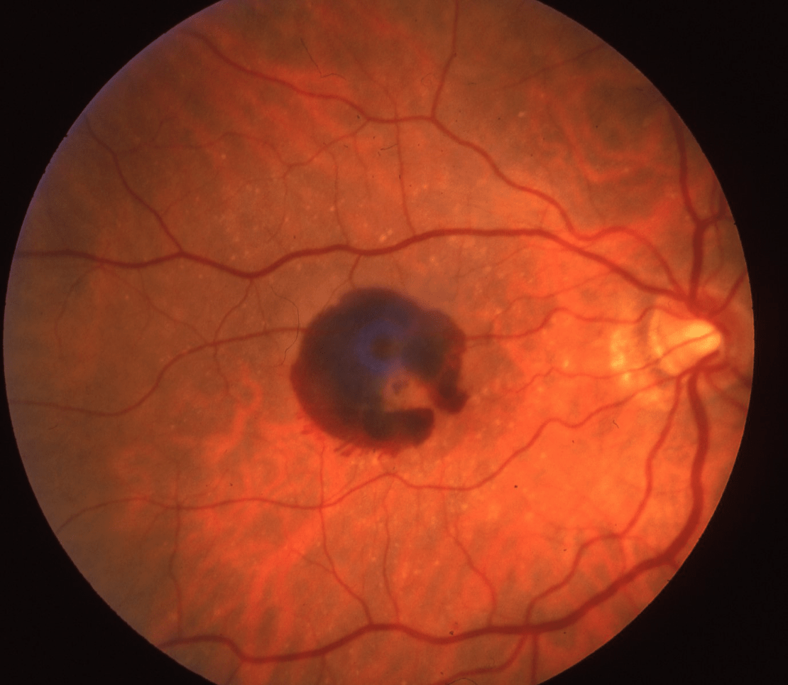 macular degeneration wet amd